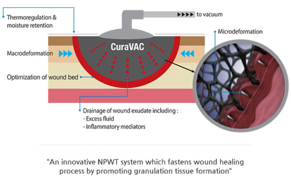 Negative Pressure Wound Therapy - Image 5